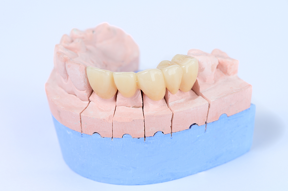 セラミック治療